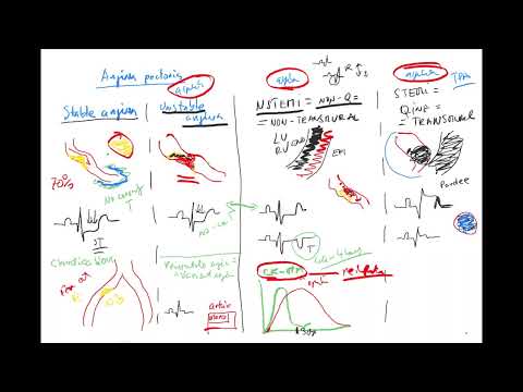 ACS 3b ENG (Acute coronary syndrome, myocardial infarction, STEMI, NSTEMI, Q infarction, transmural)