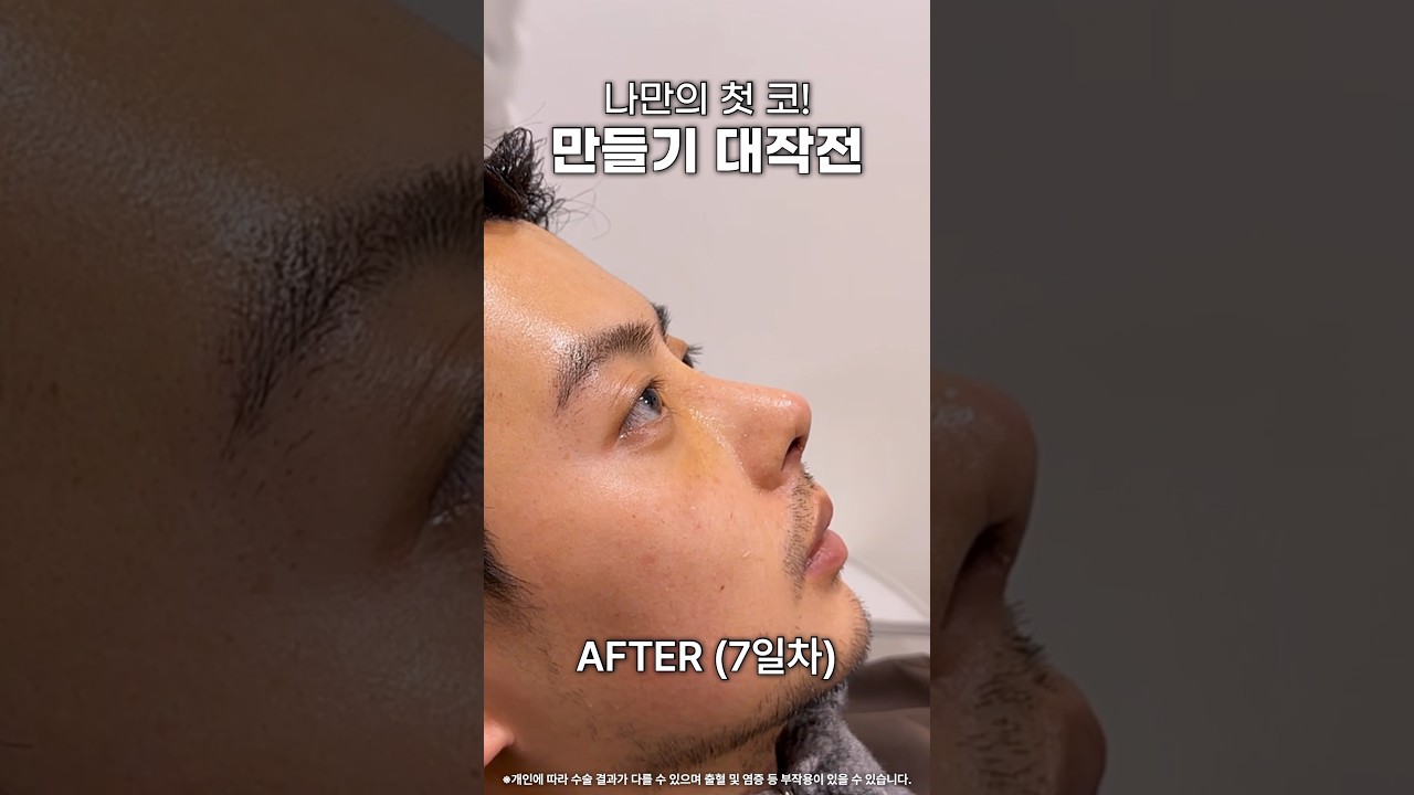 코성형(무보형물, 비중격, 기증늑, 매부리코, 코끝처짐교정, 휜코, 비순각교정)