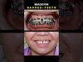 BRACES FOR GAPPED TEETH 32 MONTHS DURATION Braces Orthodontist Dentist