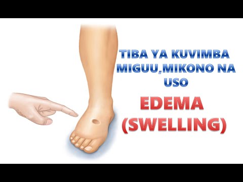 , title : 'TIBA YA KUVIMBA MIGUU, MIKONO NA USO | EDEMA (SWELLING)'