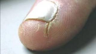 DermTV - How to Heal Cracked Fingertips [DermTV.com Epi #125]