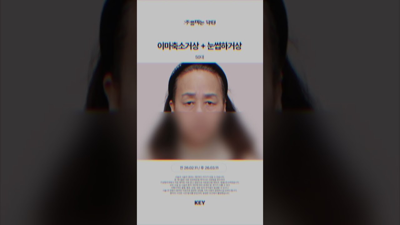대구50대 중반의 이마 축소 거상