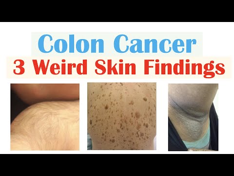 , title : '3 Weird Signs of Colon Cancer (Found on the Skin)'