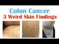 3 Weird Signs Of Colon Cancer Found On The Skin
