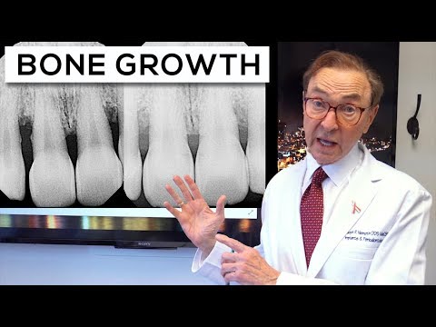 AMAZING Results With LANAP | Gum Disease Treatment