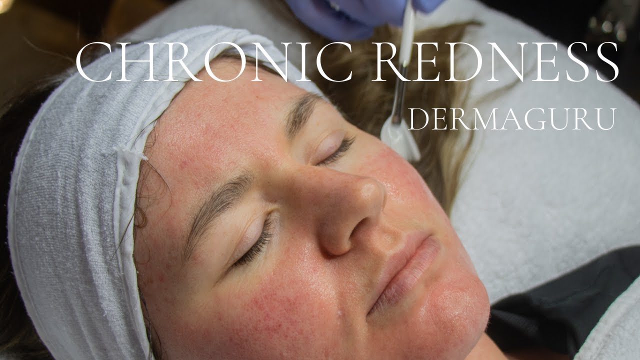 pHformula chronic redness advanced resurfacing treatment | DERMAGURU