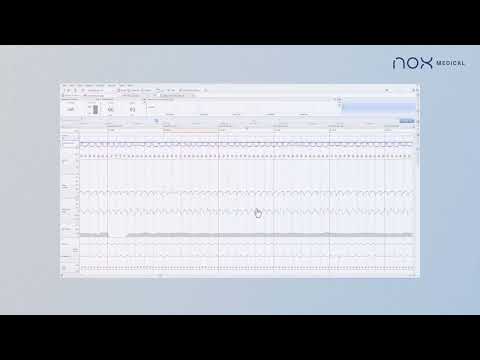 Total Sleep Time Tool in Noxturnal Software