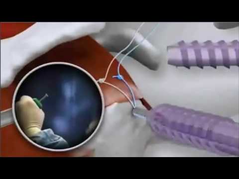 Ernia del rimedio popolare colonna cervicale Articolazioni artritiche delle mani del codice ICD