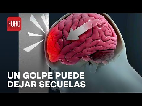 ¿Qué tan peligroso es un golpe en la cabeza? - Sábados de FORO