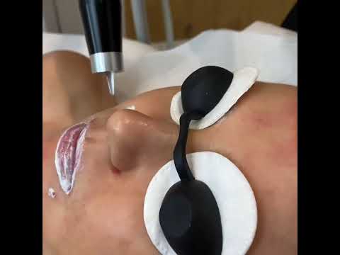 Laserowe usuwanie przebarwień