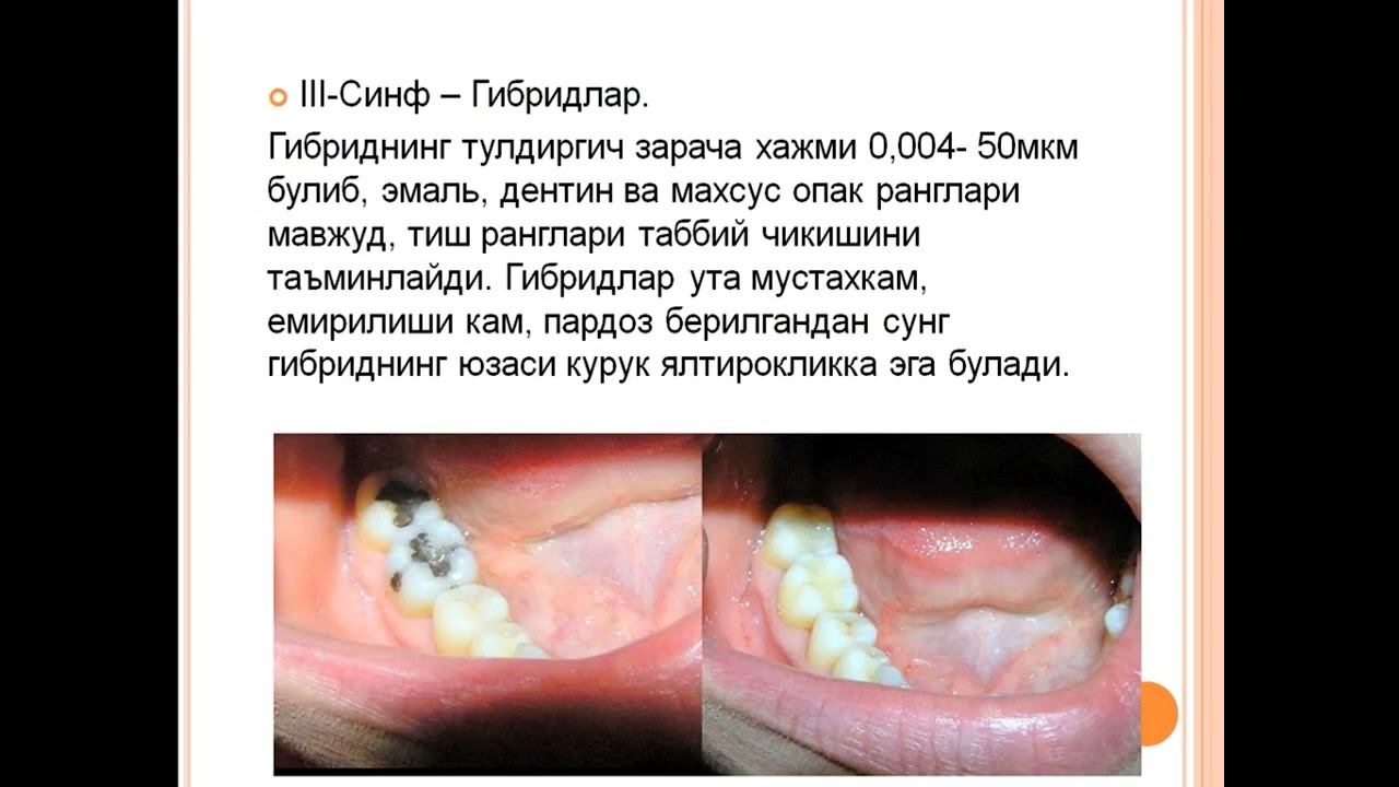 Kompozit plomba ashyolari. Tasnifi. Kimyoviy qotuvchi kompozitlar