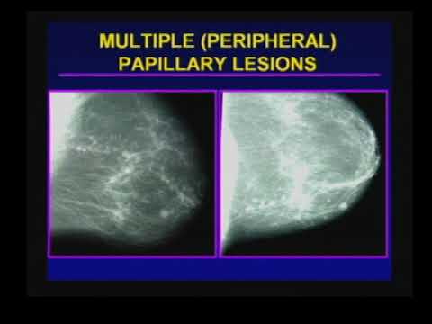Papillary thyroid cancer nuclear medicine
