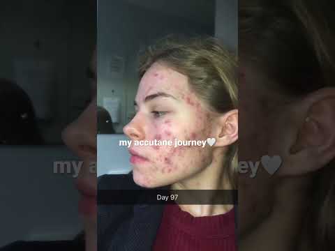 My accutane journey 💗 #acne