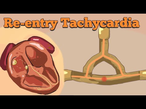 Reentry Tachycardia | AVNRT, AVRT (including WPW-syndrome)