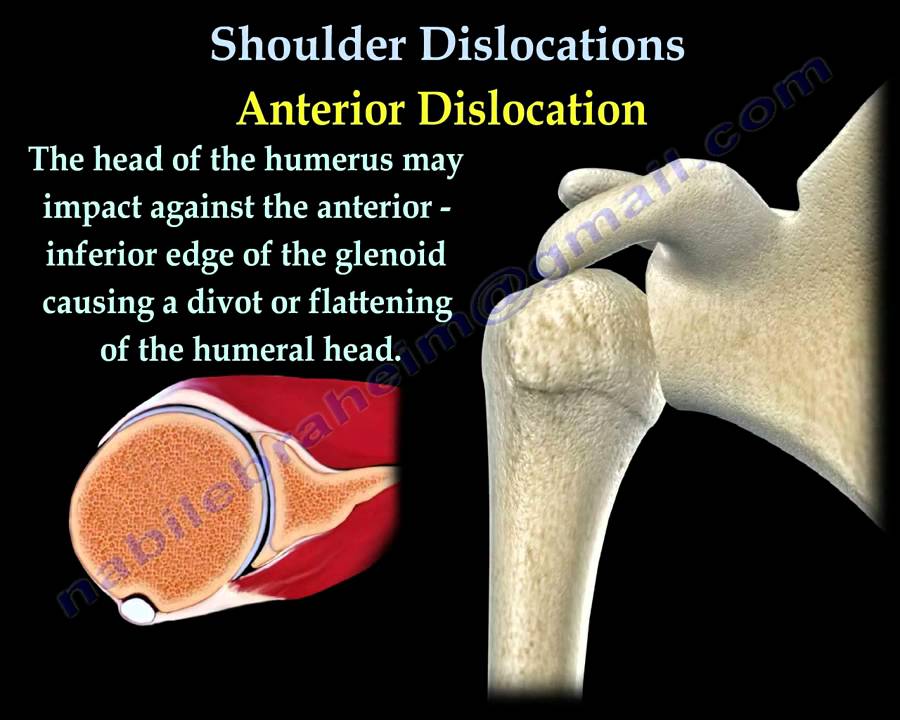 Shoulder Dislocations ,Everything You Need To Know - Dr. Nabil Ebraheim - YouTube