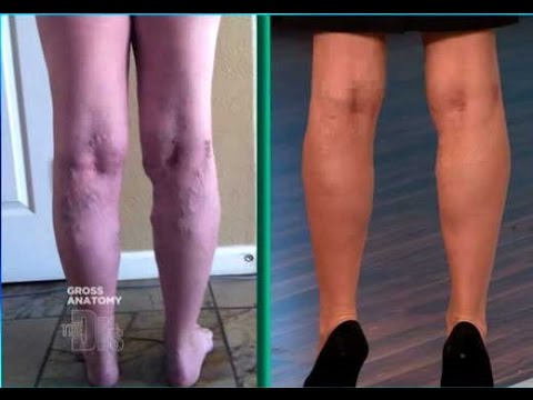 Kung paano mangayayat sa 10 kg bawat linggo bata 11 taon nang walang pagdidyeta Erica Herceg larawan pagkatapos pagbaba ng timbang