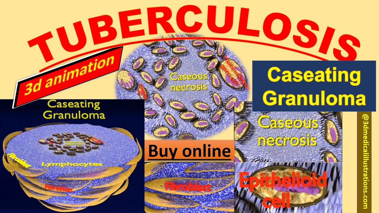 3D Caseating granuolma tuberculosis labelled model 3D Model