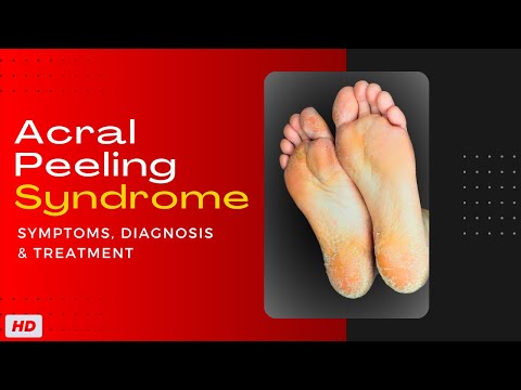 Sunburn Causes Signs and Symptoms Diagnosis and Treatment