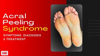 Acral Peeling Syndrome: Symptoms, Diagnosis and Treatment