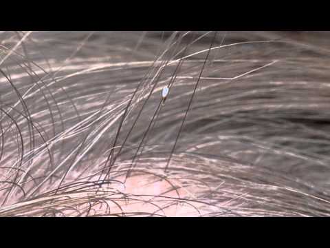 My over the counter headlice products aren't working