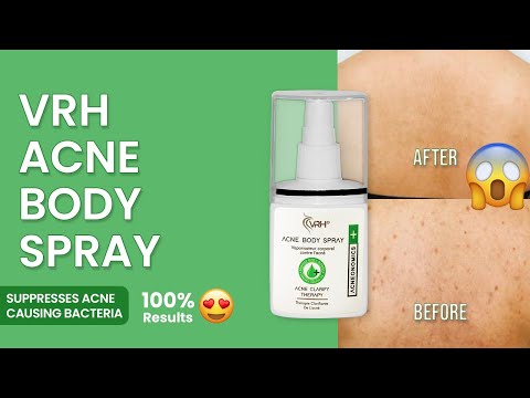 Unisex acne marks remover spray, liquid, packaging size: reg...
