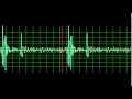 Normal Heart Sound- normal speed