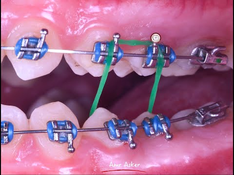 Scissor bite correction in orthodontics by cross elastic band