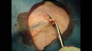 Flebectomia Ambulatoria