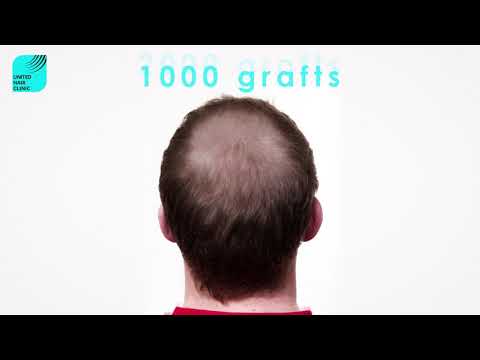 UnitedHairClinic.com