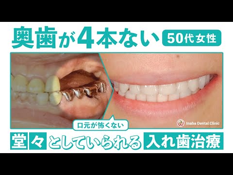 奥歯が4本ない（50代女性〜口元が怖くない、堂々としていられる入れ歯治療〜）