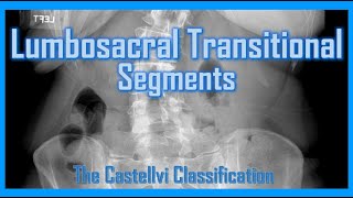 Lumbosacral Transitional Segments - LSTV