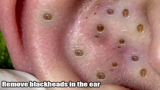 Remover big Blackhead in Ear