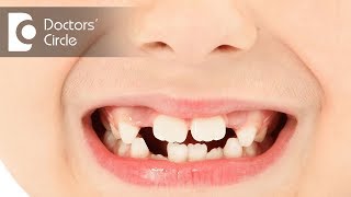 Why children grind their teeth & treatment for it? - Dr. Premila Naidu