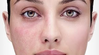 How To Get Rid Of Redness On Face - Causes of Redness On Face.