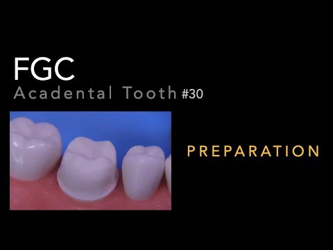 Full Gold Crown Preparation - #30 Acadental Tooth