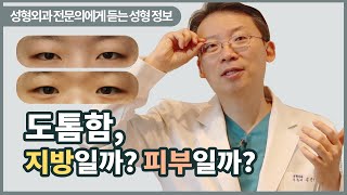 쌍꺼풀 수술 전 필수 영상 '내눈은 지방형?피부두께형?'