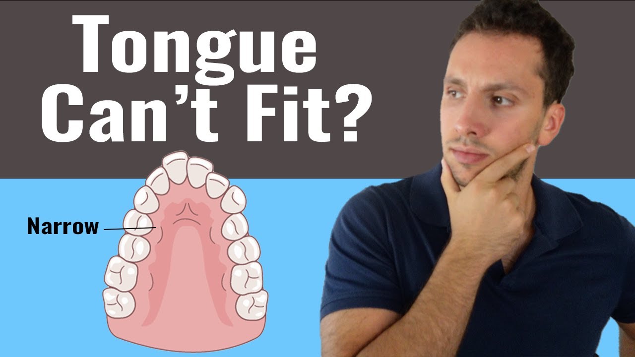 Can you do Mewing if You Have a Narrow Palate?