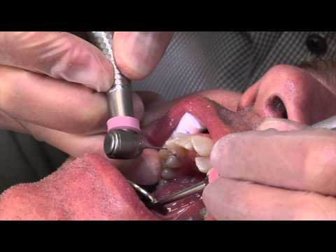 Invisalign - poliuretanowe nakładki ortodontyczne cz. 2 