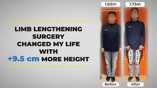 How Limb Lengthening Surgery changed my life with +9.5 cm more height | One Year After Surgery