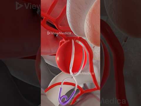Brain Aneurysm Clipping (3D Animation)