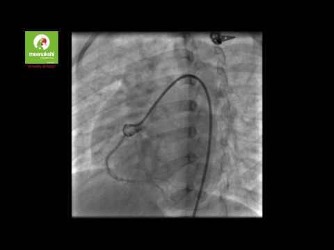 Congenital Coronary Cameral Fistula