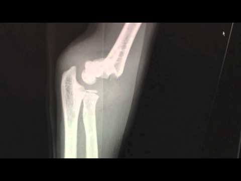 Supracondylar Fractures