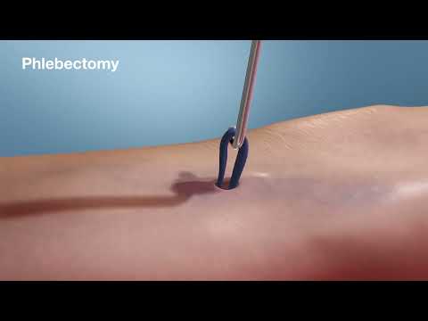 Varicose Vein Treatment Options