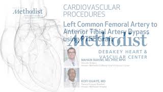 Download Lagu Left Common Femoral Artery to Anterior Tibial Artery Bypass using PTFE Graft (Rahimi, MD, Quaye, MD) Thumbnail