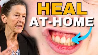 Quickly Heal Gingivitis & Bleeding Gums Naturally at Home
