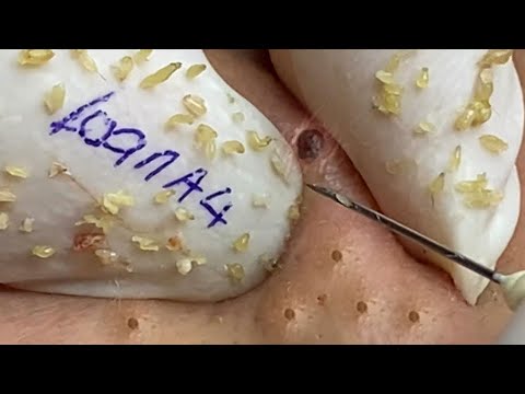 SAC DEP SPA acne treatment and removal blackheads