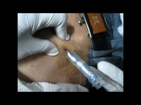 Kerosin für Prostatitis Schmerzen in der Prostata nach dem Urinieren