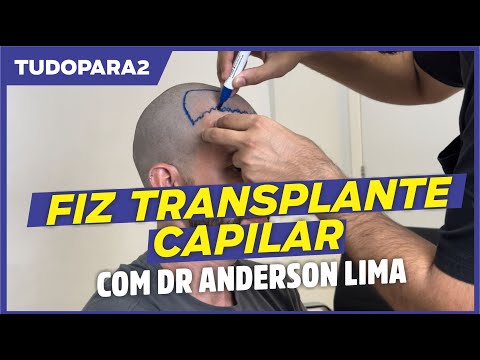 tudopara2 | Fiz transplante capilar com Dr Anderson Lima em Delmiro Gouveia AL (relato)