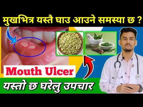 मुखभित्र आउने घाउको उपचार ? Causes and Treatments of Mouth Ulcer , Canker Sore , Apthous Stomatitis