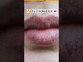 Dry Lips Home Remedy Dry Cracked Lips Treatment Shorts Drylips Viral Ytshorts